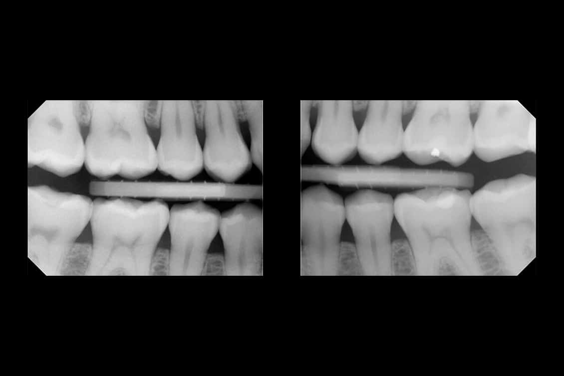 Tannleger hos Kolbotn Tannklinikk tar tannbilde-røntgen for nøyaktig diagnostikk – Oppegård, Sofiemyr, Follo. av tennenes tilstand – trygg behandling i Oppegård og Kolbotn.