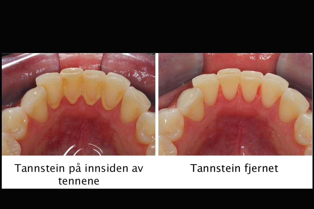 Galleri: Ved Kolbotn Tannklinikk renses fortenner for tannstein – trygt i Oppegård, Vinterbro, Sofiemyr.