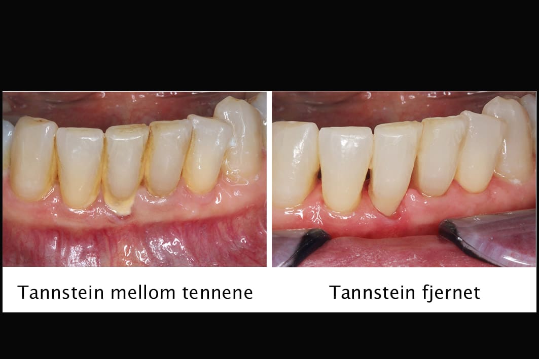 Ved Kolbotn Tannklinikk viser tannlegene hvordan rens gir renere tenner og friskere smil – tannklinikk i Kolbotn, Follo og Vinterbro.