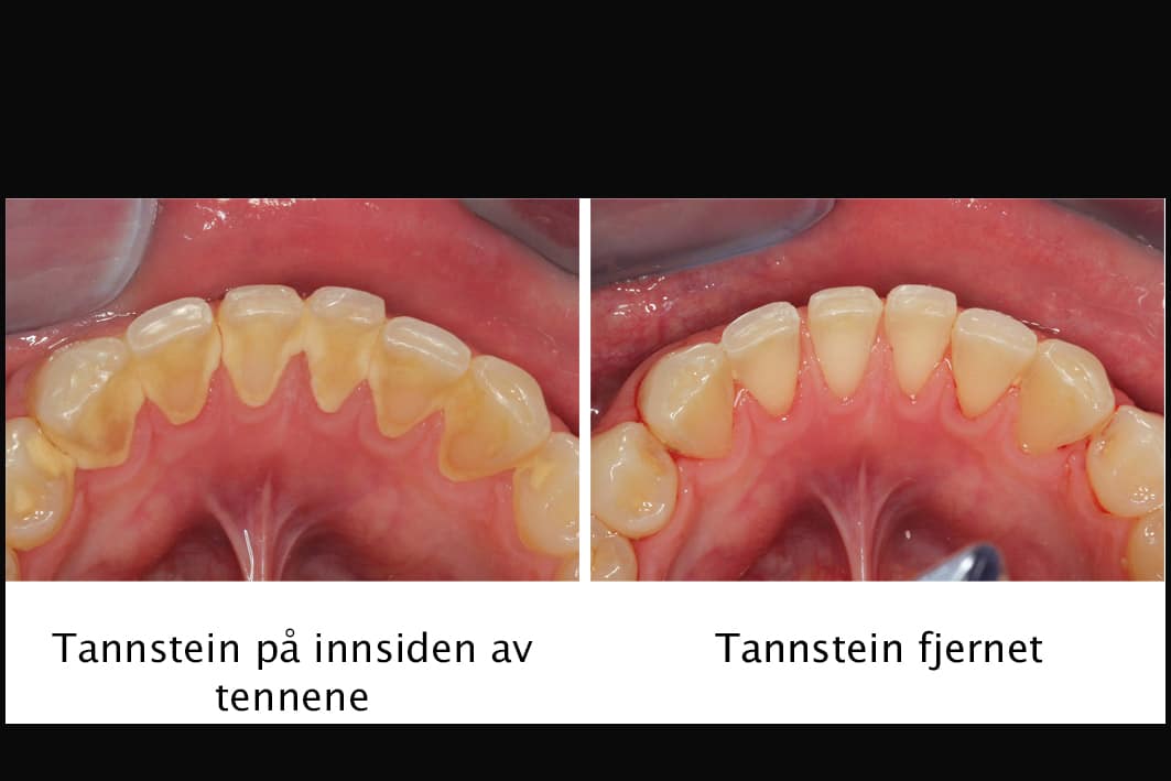 Tannleger på Kolbotn Tannklinikk fjerner tannstein på fortenner – profesjonell tannbehandling i Kolbotn, Holmlia, Nordstrand og Myrvoll.