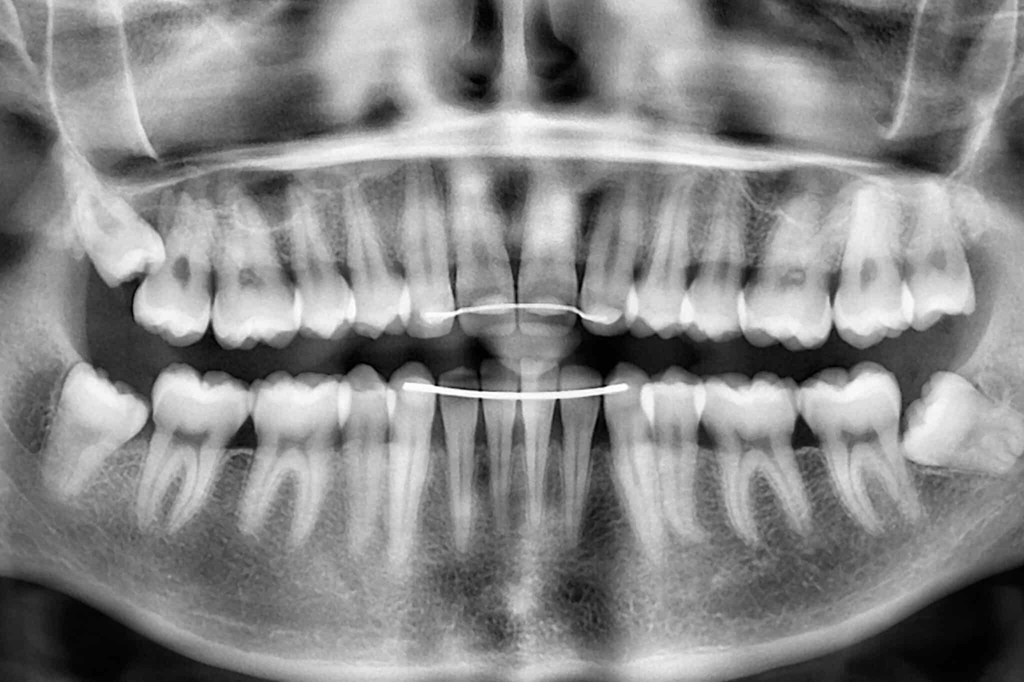 Ved Kolbotn Tannklinikk tar tannleger OPG panoramarøntgen for helhetlig oversikt over kjeve, tenner og bihuler – brukt i Kolbotn, Follo og Nordstrand.