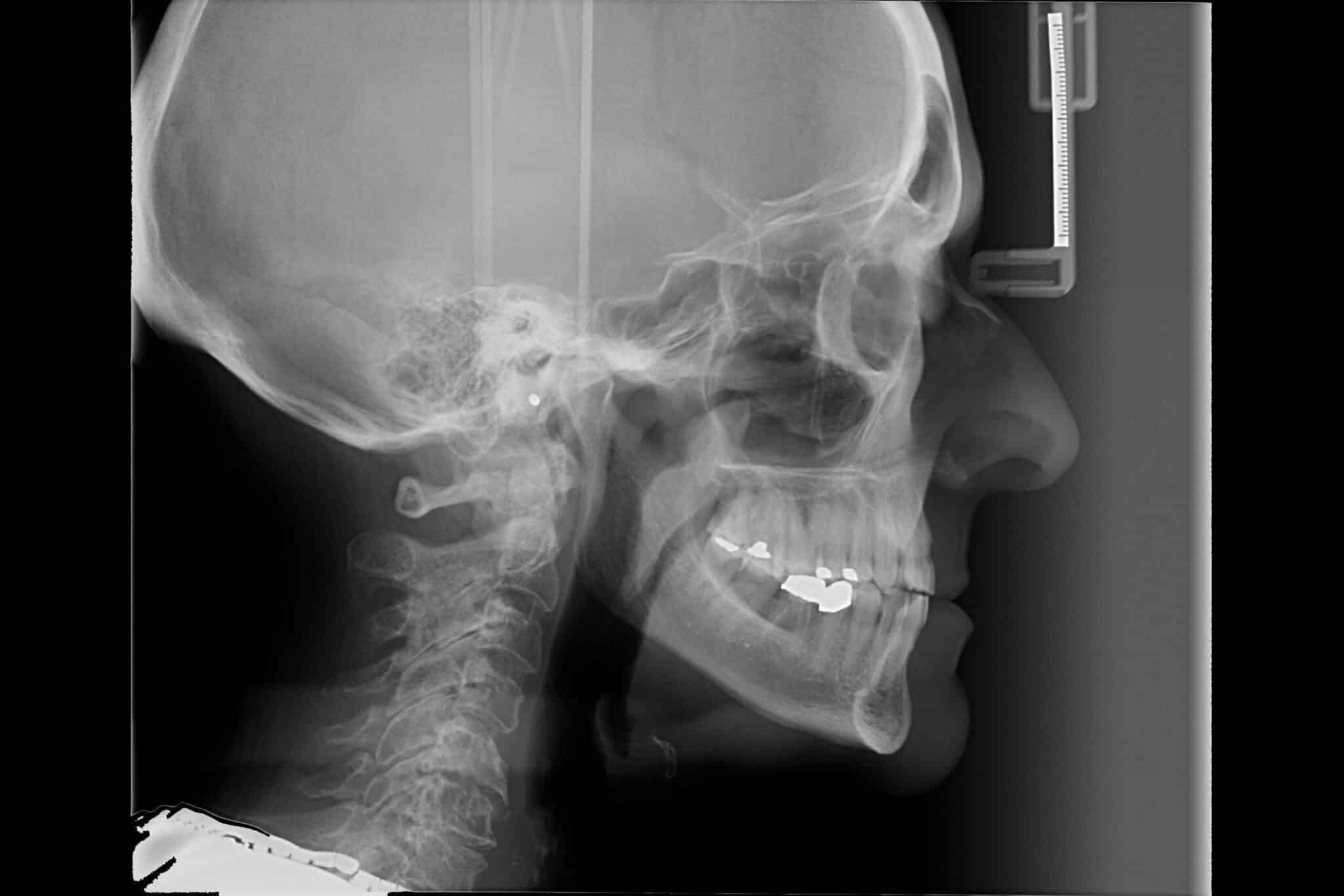 Kolbotn Tannklinikk bestiller cephalometriske røntgenbilder for vurdering av kjeve- og hodeskalle – trygge tannleger i Kolbotn, Follo og Vinterbro.