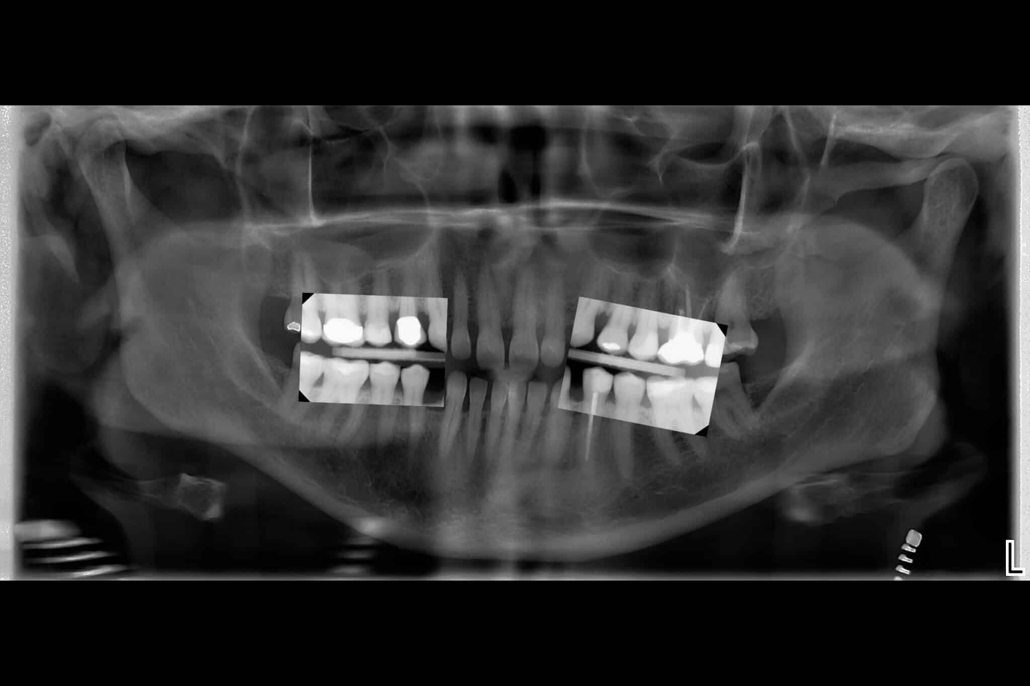 Tannleger på Kolbotn Tannklinikk viser forskjellen mellom bitewing og OPG – presis tannbehandling i Kolbotn, Follo og Hauketo.