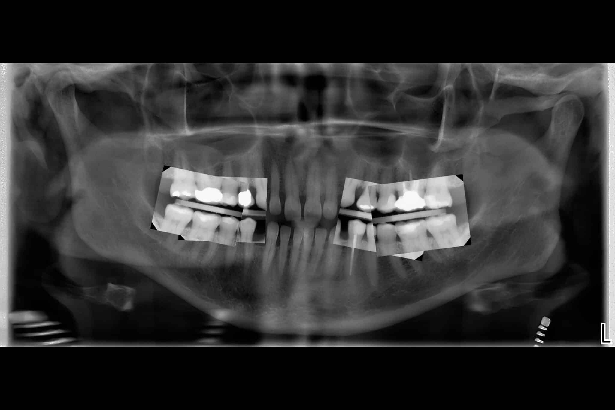 Hos Kolbotn Tannklinikk kombineres bitewing og OPG for full oversikt over tannsett og kjeve – Kolbotn, Oppegård og Holmlia.
