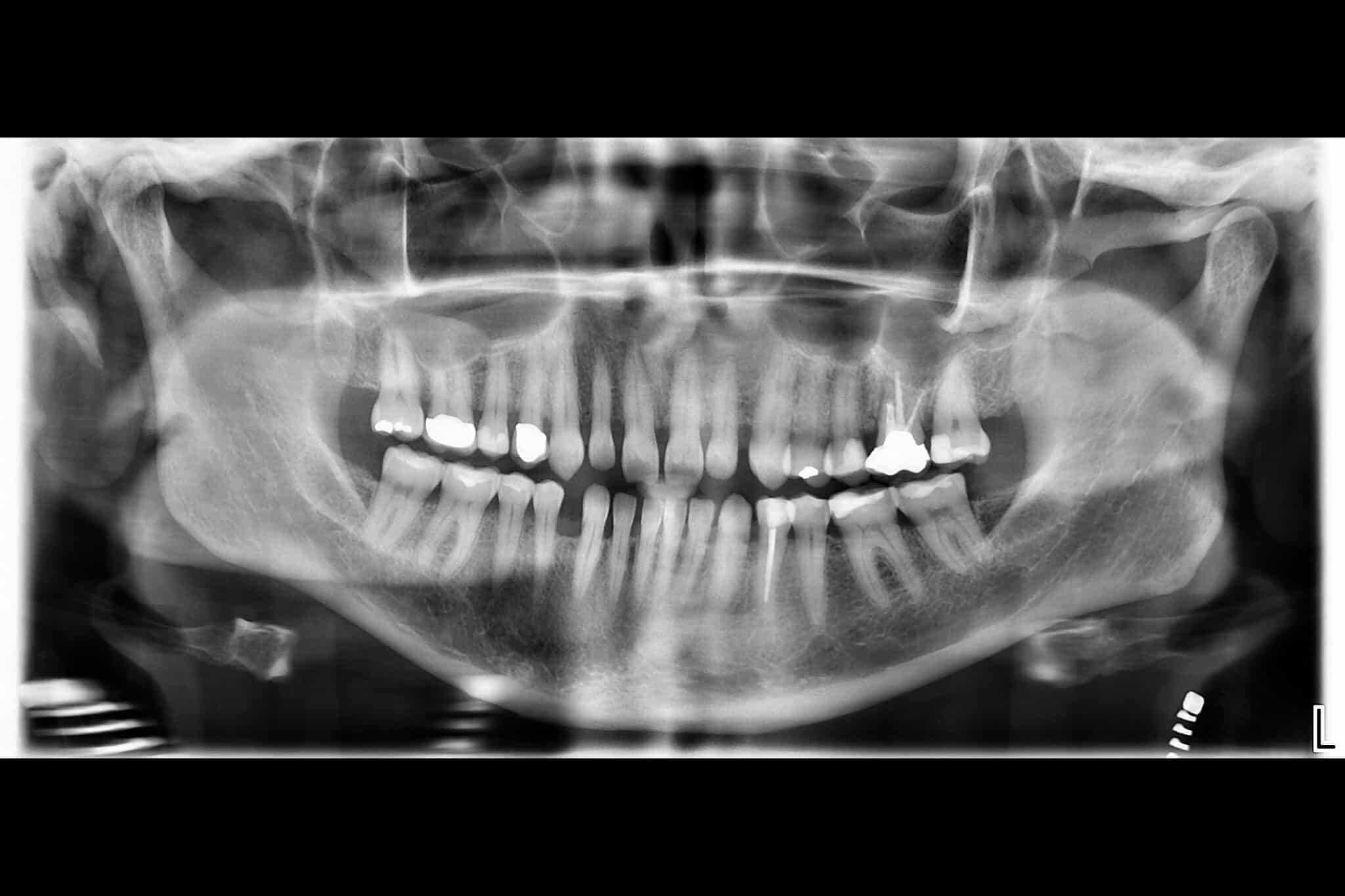Hos Kolbotn Tannklinikk kombineres bitewing og OPG for full oversikt over tannsett og kjeve – Kolbotn, Oppegård og Holmlia.