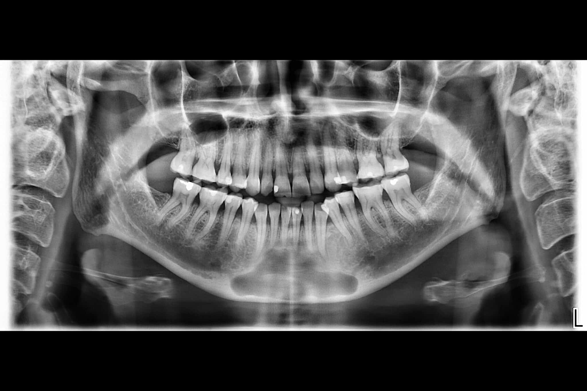 Ved Kolbotn Tannklinikk sammenligner tannlegene OPG og CBCT for nøyaktig planlegging av behandling – Kolbotn, Vinterbro og Nordstrand.