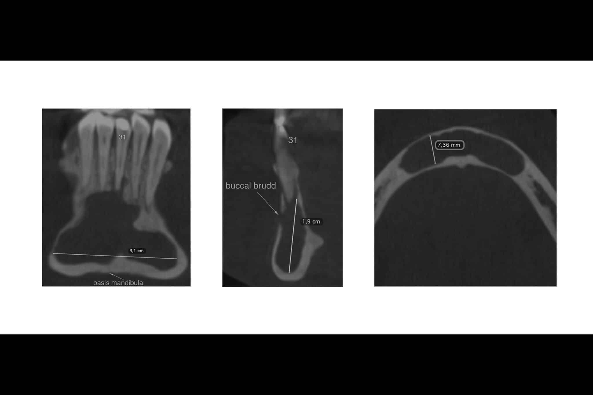 Ved Kolbotn Tannklinikk sammenligner tannlegene OPG og CBCT for nøyaktig planlegging av behandling – Kolbotn, Vinterbro og Nordstrand.