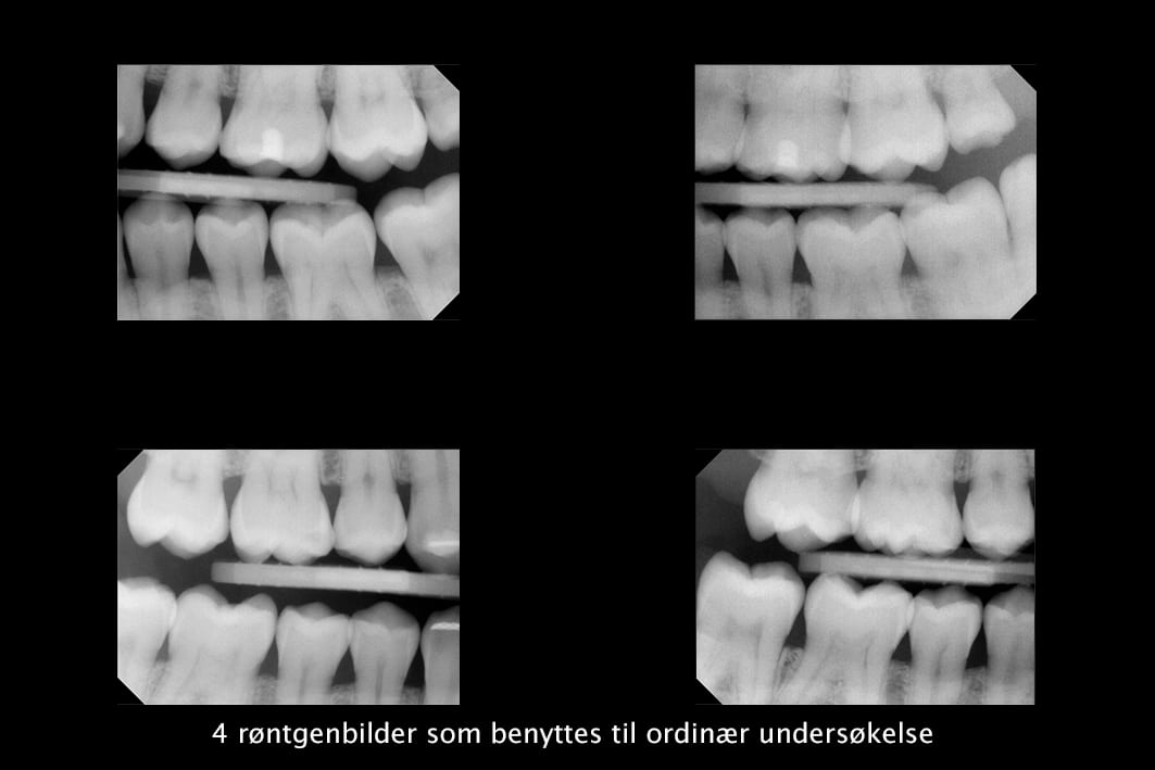 Tannlegene ved Kolbotn Tannklinikk bruker bitewing-røntgen for å oppdage karies og tannkjøttsykdom – tannklinikk i Kolbotn, Oppegård og Follo.