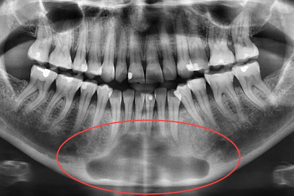 Hos Kolbotn Tannklinikk oppdager tannlegene kjevecyster med moderne røntgen – trygg tannlege i Kolbotn, Oppegård og Follo.