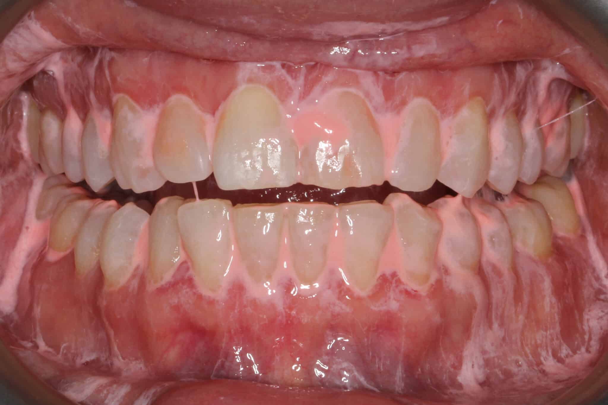 Tannlegene ved Kolbotn Tannklinikk bruker pussemiddel og pussebor for å fjerne plakk og biofilm – renere tenner i Kolbotn, Oppegård og Follo.