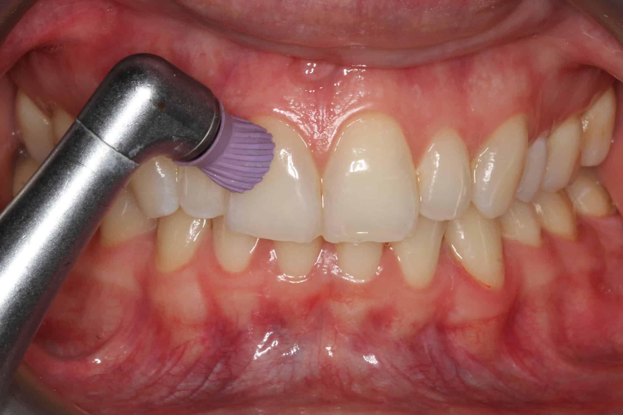 Tannlegene ved Kolbotn Tannklinikk bruker pussemiddel og pussebor for å fjerne plakk og biofilm – renere tenner i Kolbotn, Oppegård og Follo.