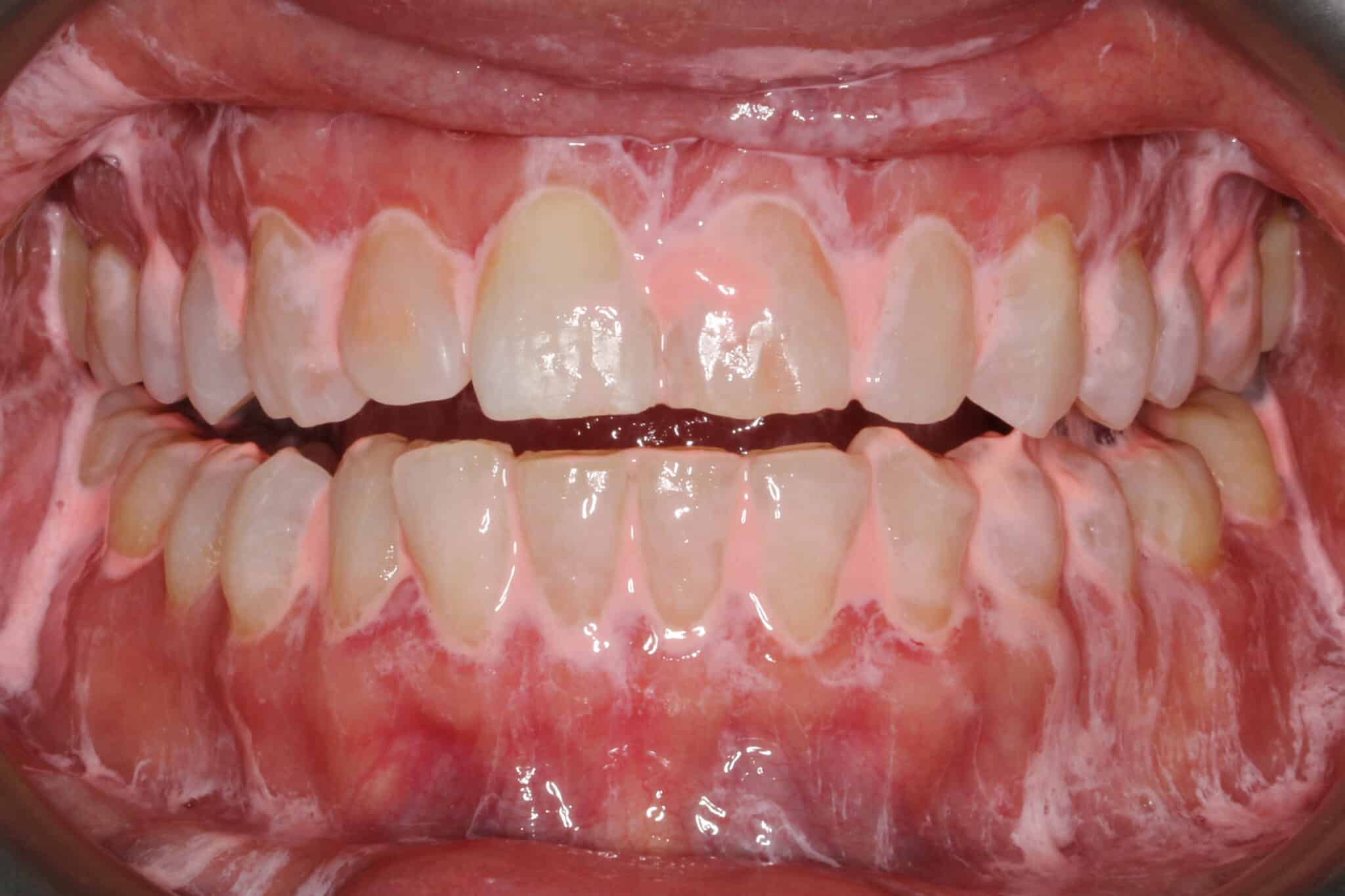 Ved Kolbotn Tannklinikk bruker tannlegene Airflow for å fjerne hardtsittende misfarging – moderne tannklinikk i Kolbotn, Oppegård og Myrvoll.