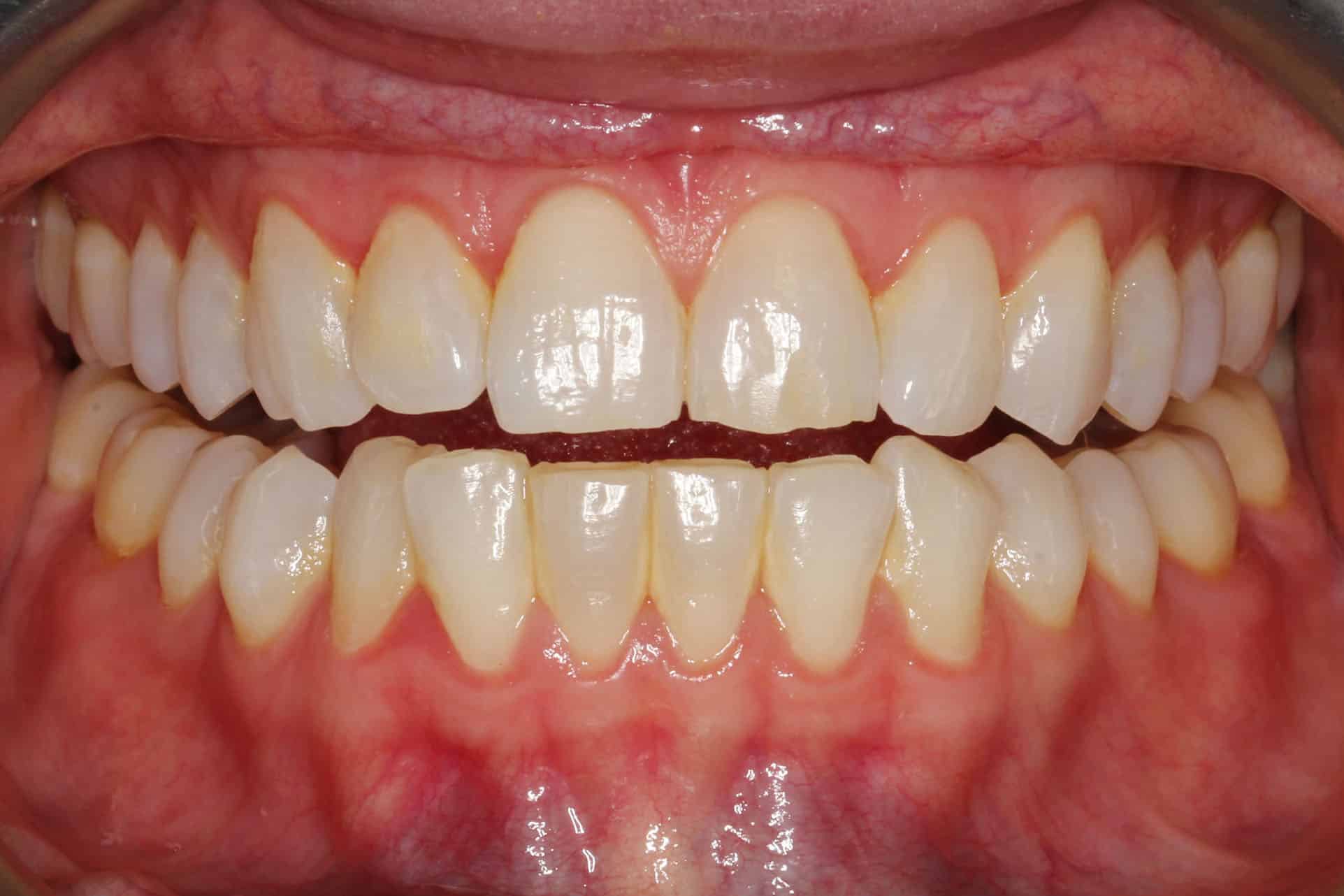 Ved Kolbotn Tannklinikk bruker tannlegene Airflow for å fjerne hardtsittende misfarging – moderne tannklinikk i Kolbotn, Oppegård og Myrvoll.