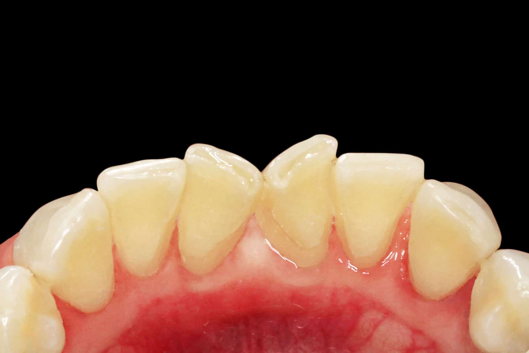 Før- og etterbilde av tannsteinfjerning i underkjeven.