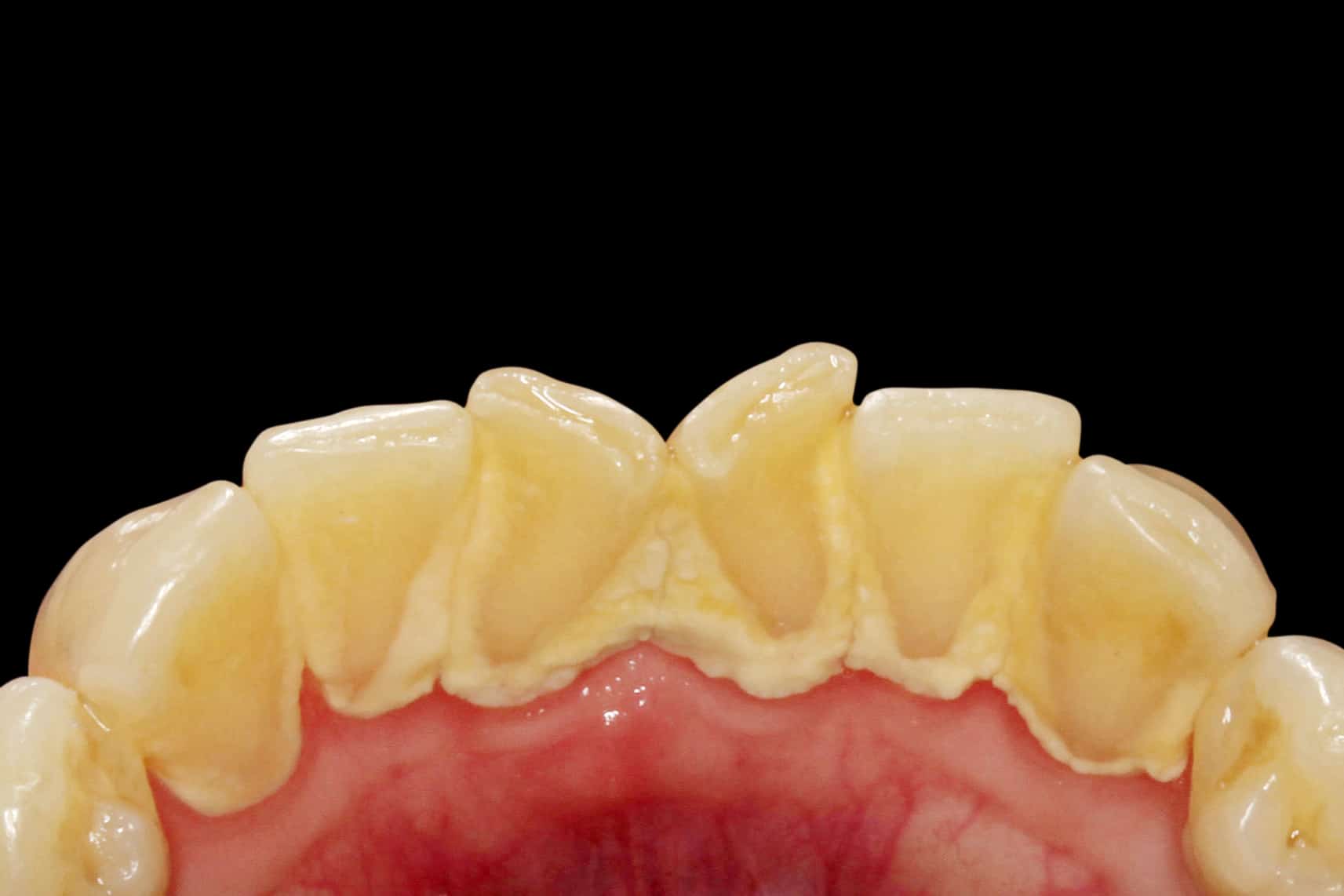 Tannlegene på Kolbotn Tannklinikk fjerner kraftig tannstein fra fortenner – tydelig effekt i Kolbotn, Holmlia og Nordstrand.