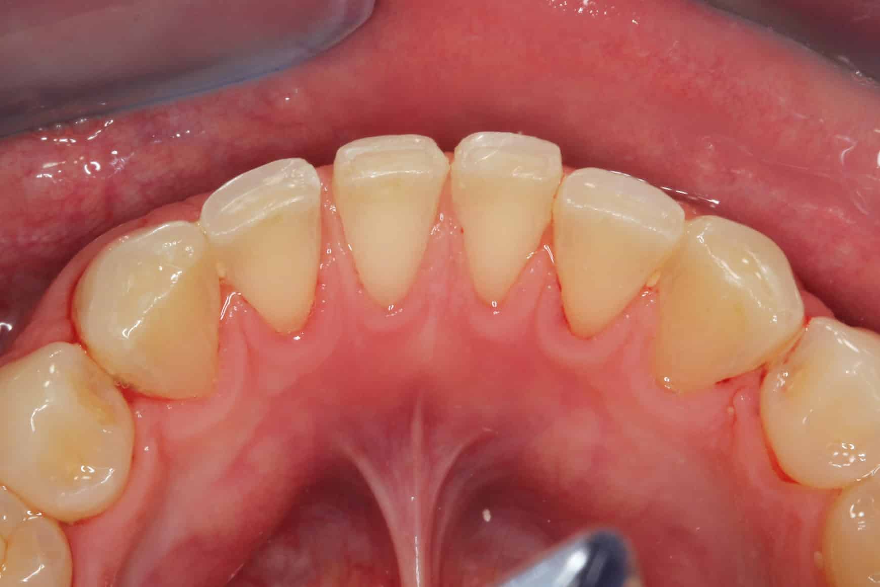 På Kolbotn Tannklinikk fjernes moderat tannstein med spesialutstyr – trygg behandling i Kolbotn, Oppegård og Myrvoll.