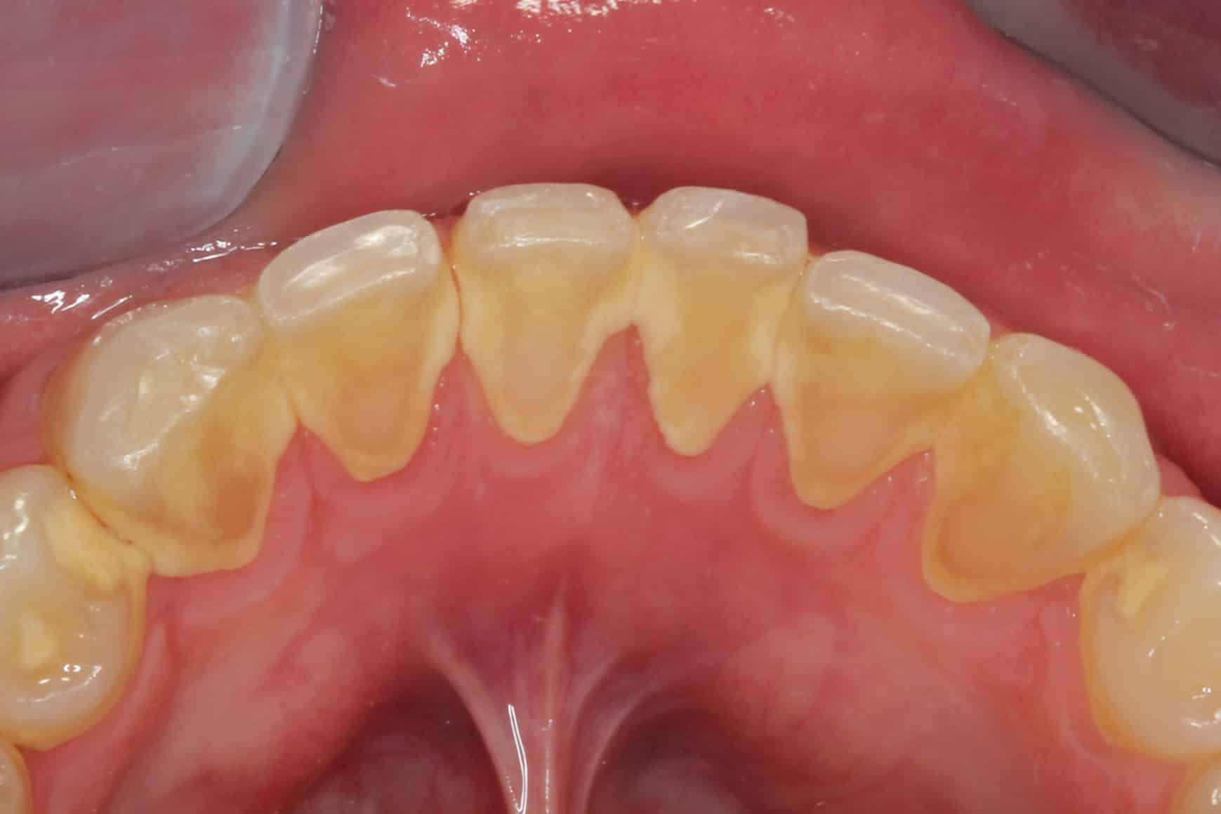 På Kolbotn Tannklinikk fjernes moderat tannstein med spesialutstyr – trygg behandling i Kolbotn, Oppegård og Myrvoll.