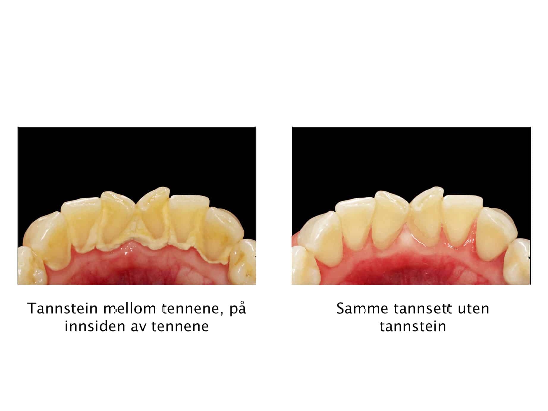 Hos Kolbotn Tannklinikk fjernes tannstein profesjonelt fra underkjevens fortenner – frisk munnhelse i Kolbotn, Vinterbro og Follo.