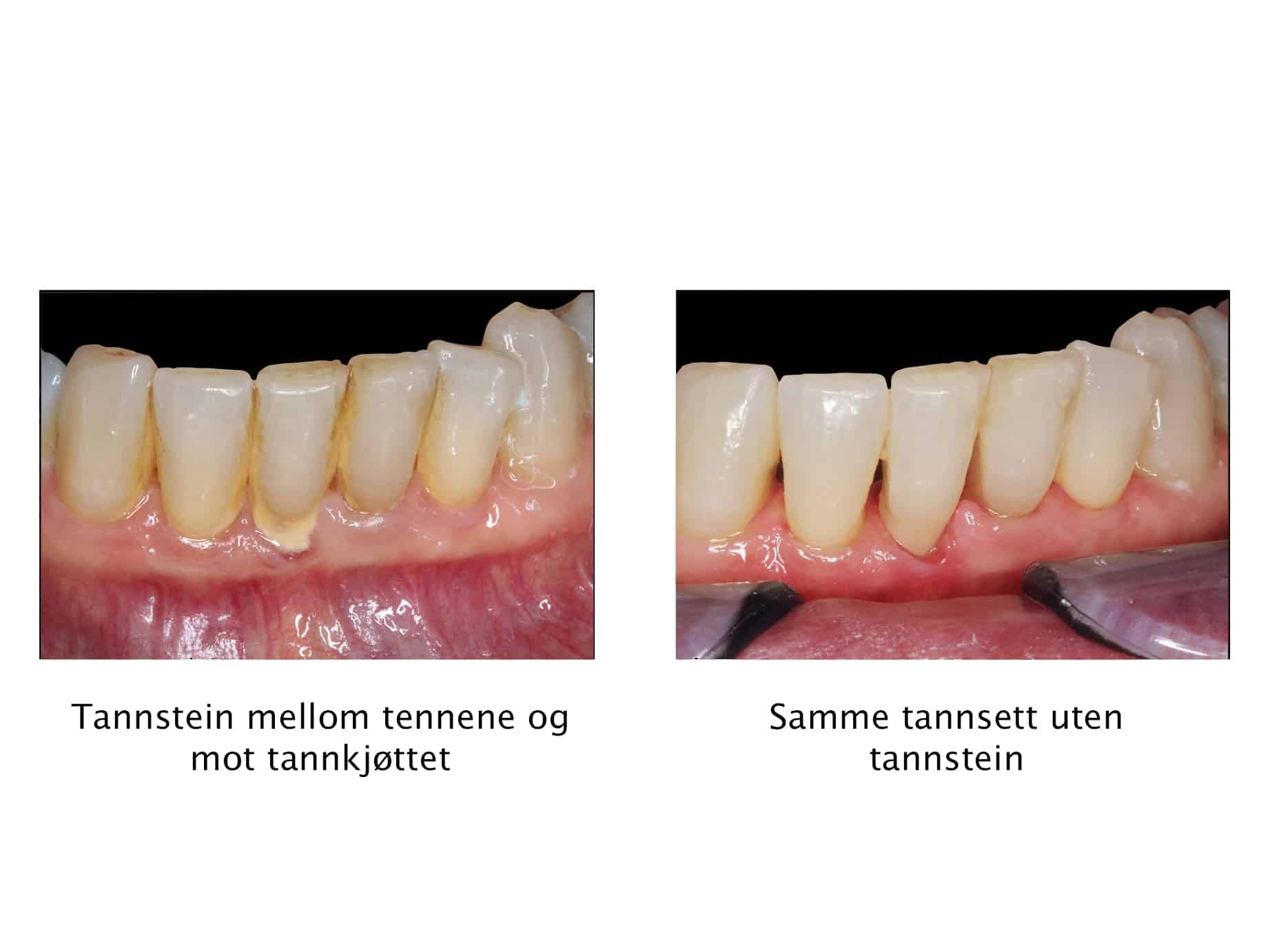 Tannleger ved Kolbotn Tannklinikk fjerner tannstein og belegg for å bevare tannkjøttets helse – tannklinikk i Kolbotn, Holmlia og Oppegård.