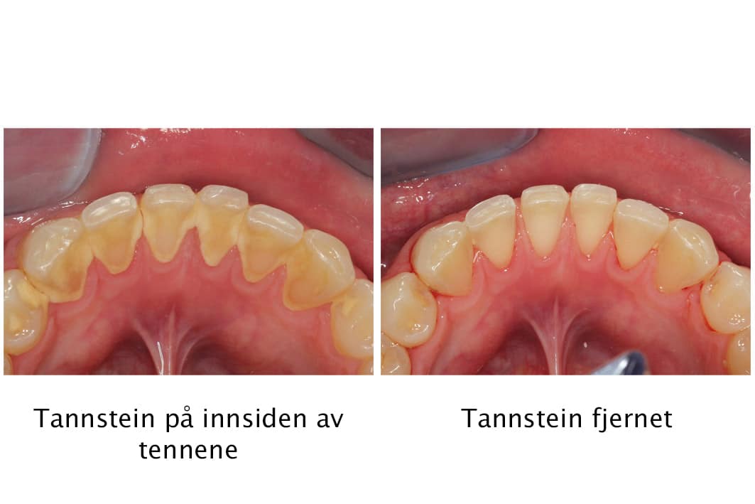 På Kolbotn Tannklinikk fjernes selv små mengder tannstein for å sikre renere tenner – tannlege i Kolbotn, Myrvoll og Nordstrand.