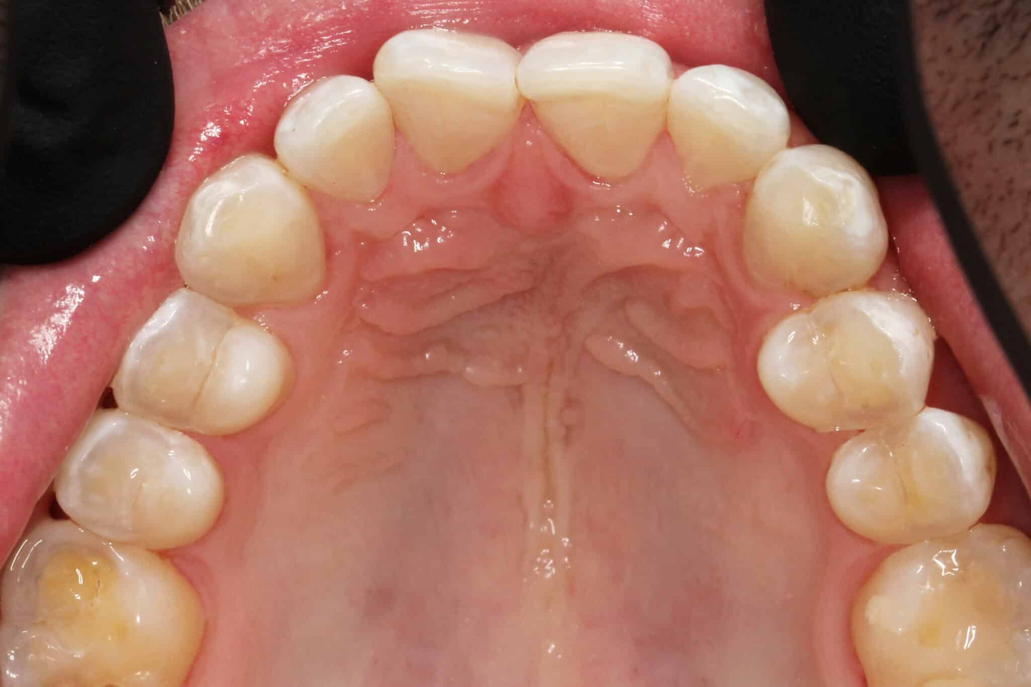På Kolbotn Tannklinikk fjerner tannlegene brunlige flekker med Airflow – friskere smil i Kolbotn, Vinterbro og Holmlia.