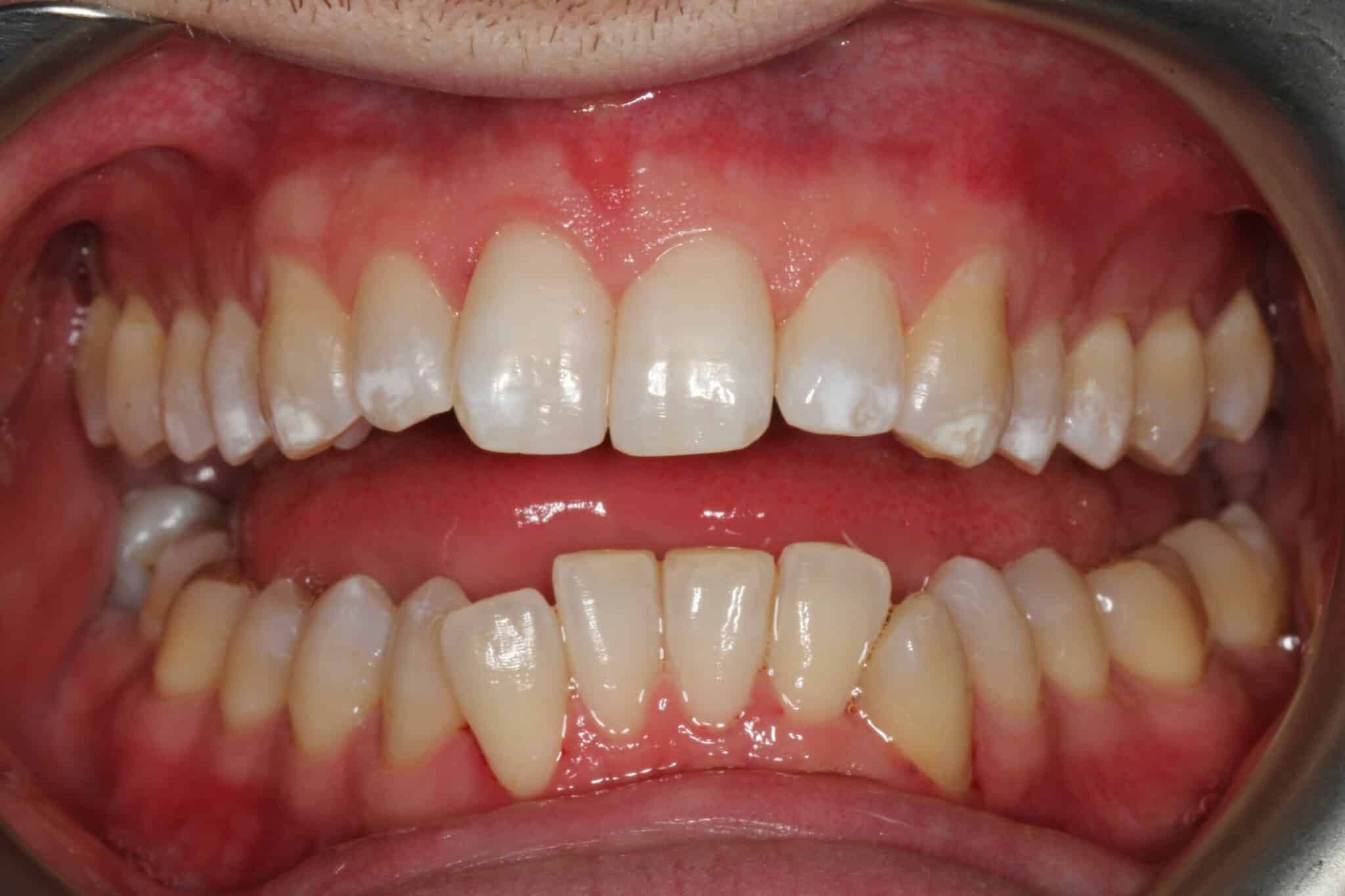 Tannlegene ved Kolbotn Tannklinikk behandler tydelig misfarging med Airflow – profesjonell tannrens i Kolbotn, Nordstrand og Follo.