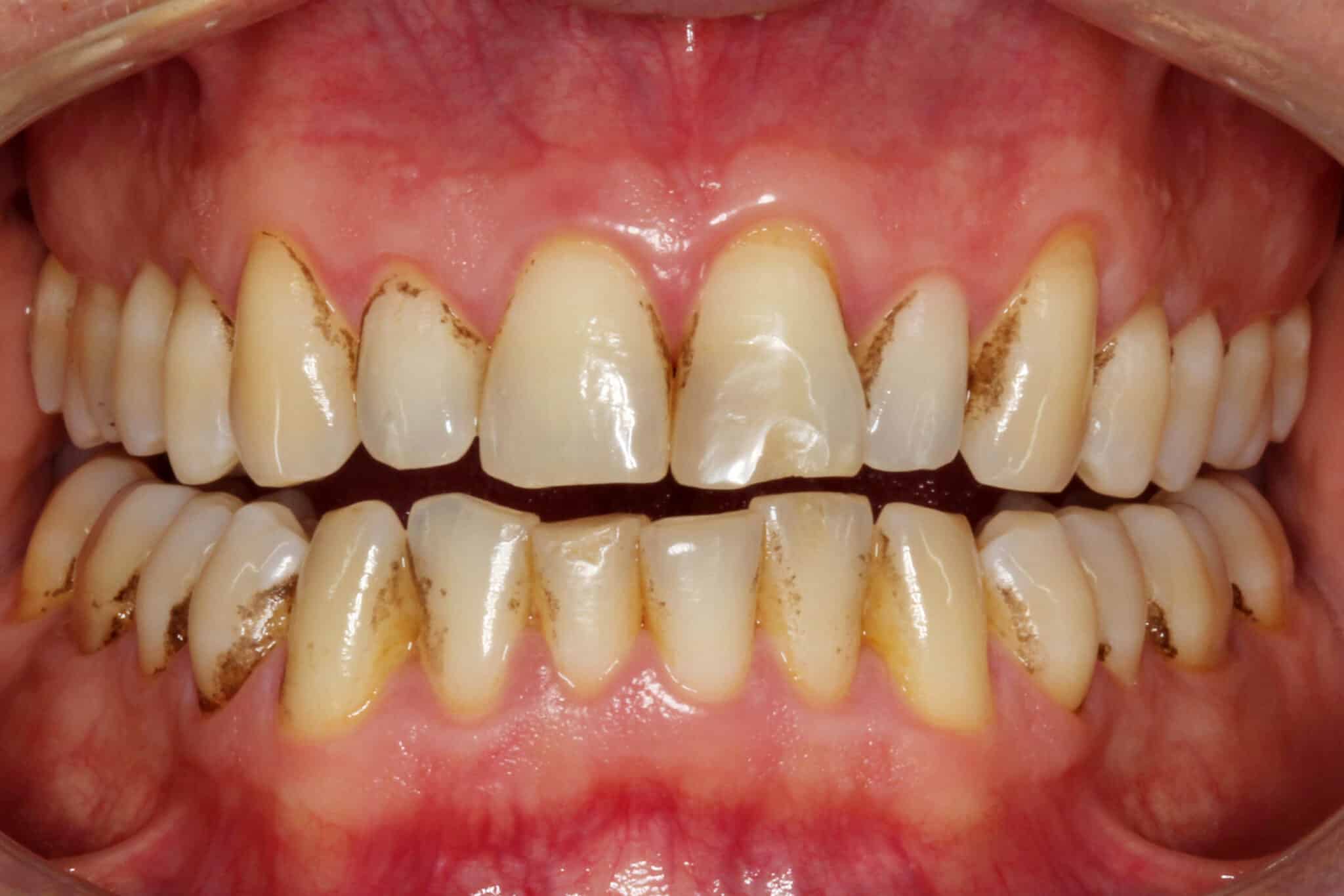 Ved Kolbotn Tannklinikk bruker tannleger Airflow for å fjerne misfarging mellom tennene – friskere smil i Kolbotn, Myrvoll og Oppegård.