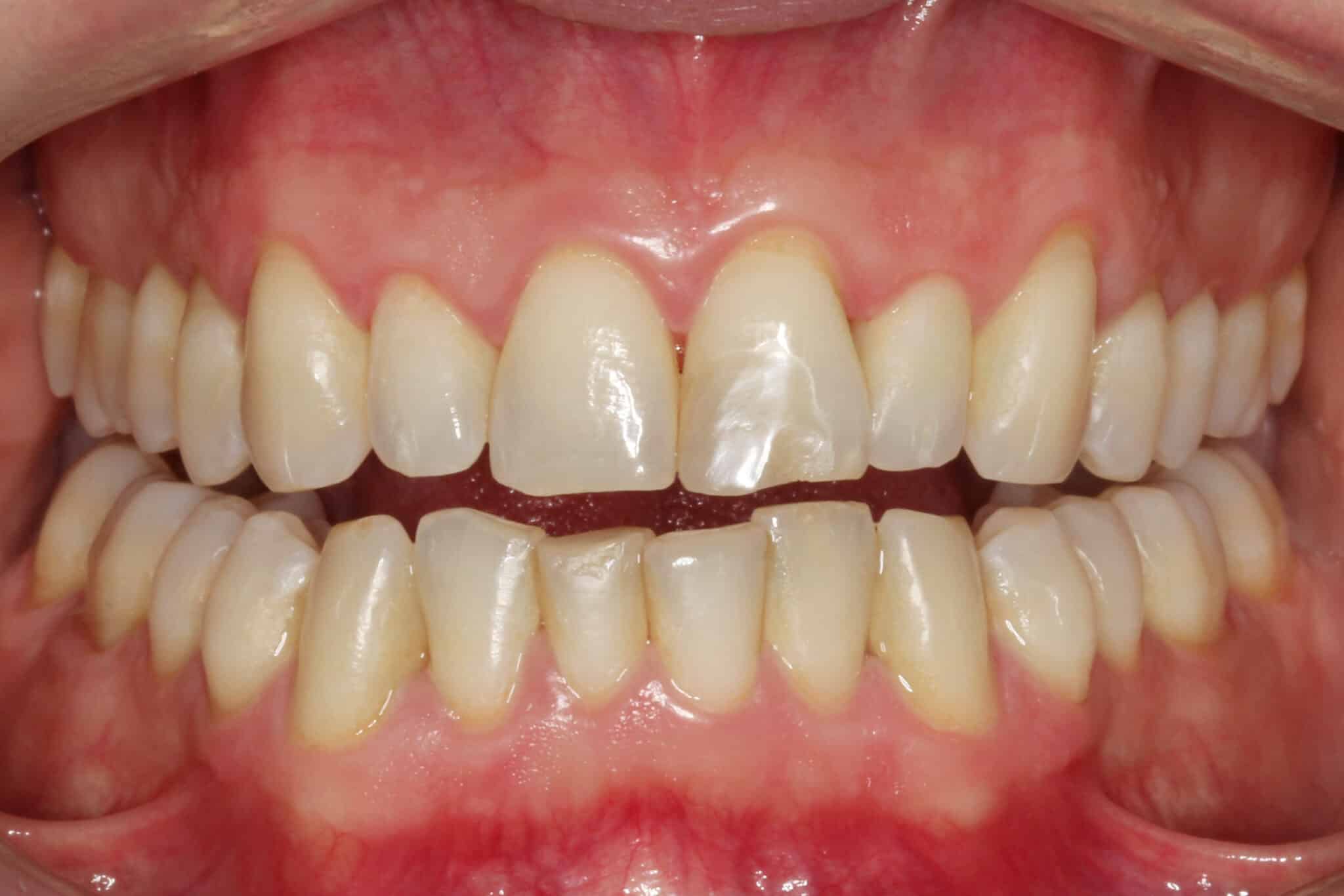 Ved Kolbotn Tannklinikk bruker tannleger Airflow for å fjerne misfarging mellom tennene – friskere smil i Kolbotn, Myrvoll og Oppegård.