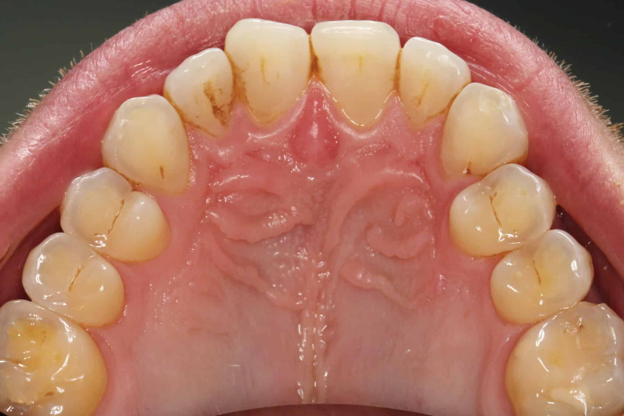 Hos Kolbotn Tannklinikk benyttes Airflow for å rense bort lett misfarging – moderne tannklinikk i Kolbotn, Hauketo og Holmlia.