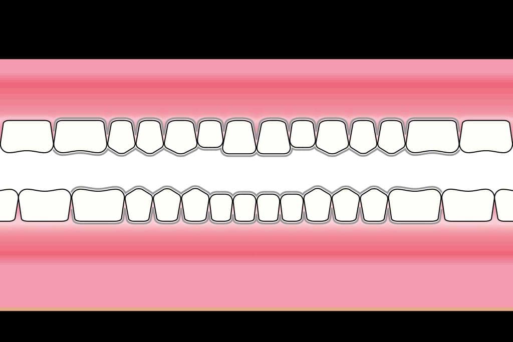 Hos Kolbotn Tannklinikk brukes blekeskinner til trygg og effektiv tannbleking hjemme – Kolbotn, Follo, Nordstrand og Sofiemyr.