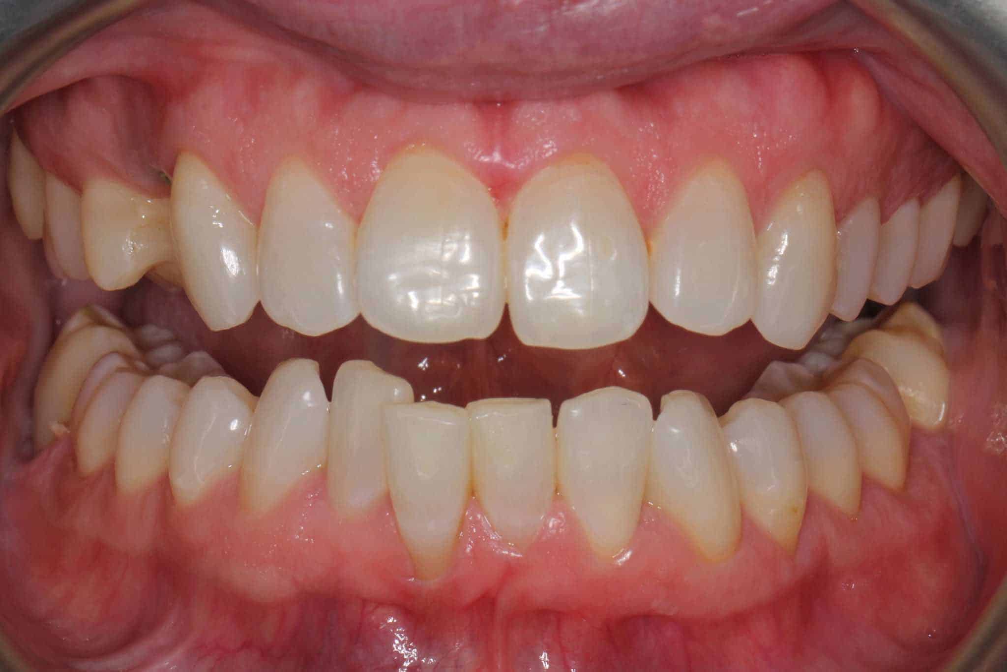 Før- og etterbilde: Hos Kolbotn Tannklinikk utføres profesjonell tannbleking med tydelig resultat – Kolbotn, Oppegård, Follo og Vinterbro.