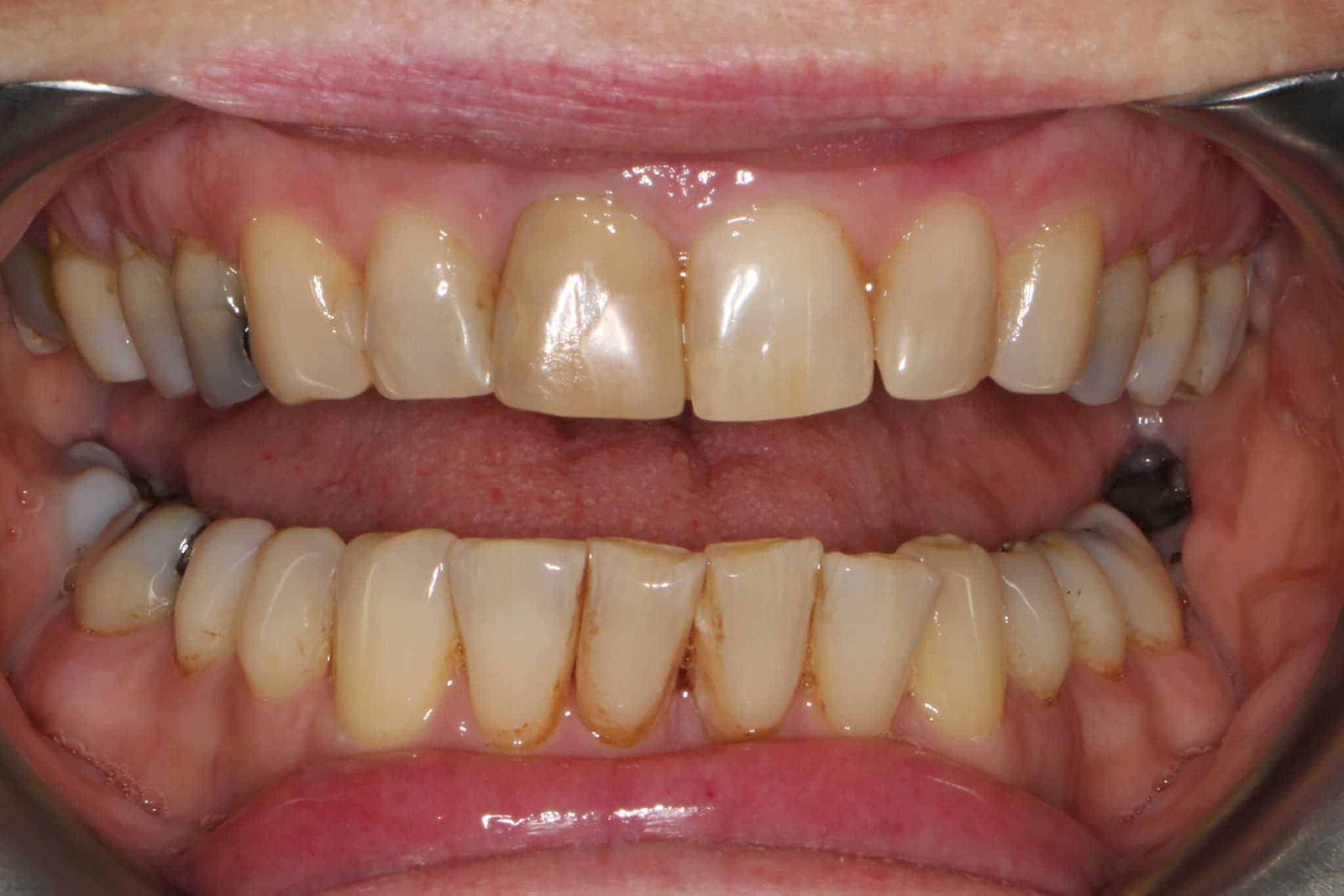 Bildet viser et tannsett bleket med blekeskinner.