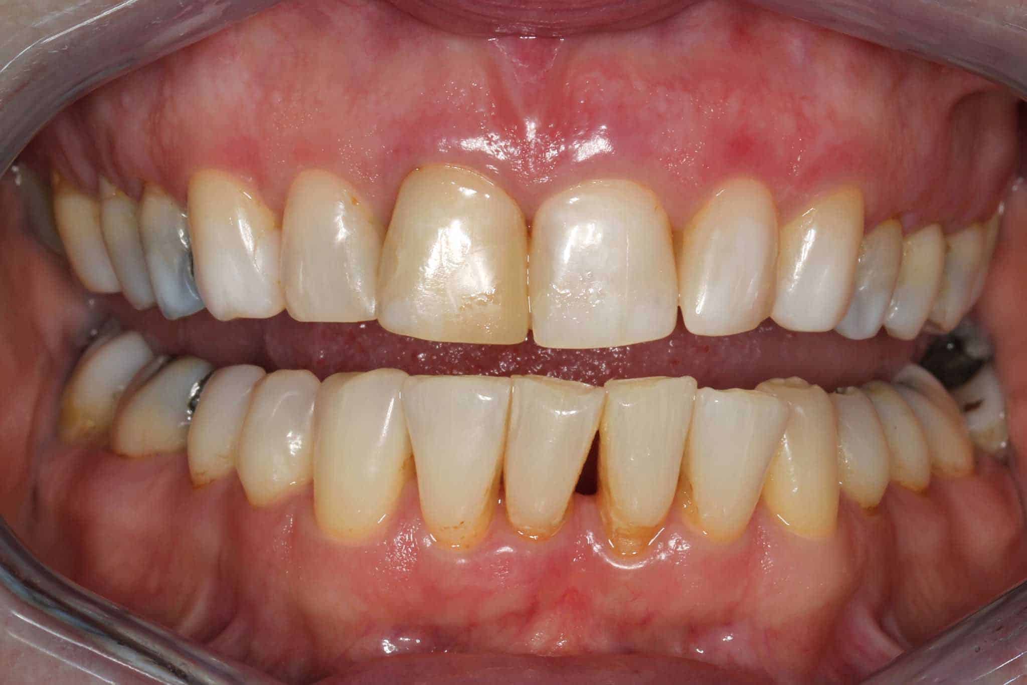 Før- og etterbilde: Tannlegene ved Kolbotn Tannklinikk viser resultat etter klinikk- eller hjemmebleking – Kolbotn, Follo, Myrvoll og Holmlia.