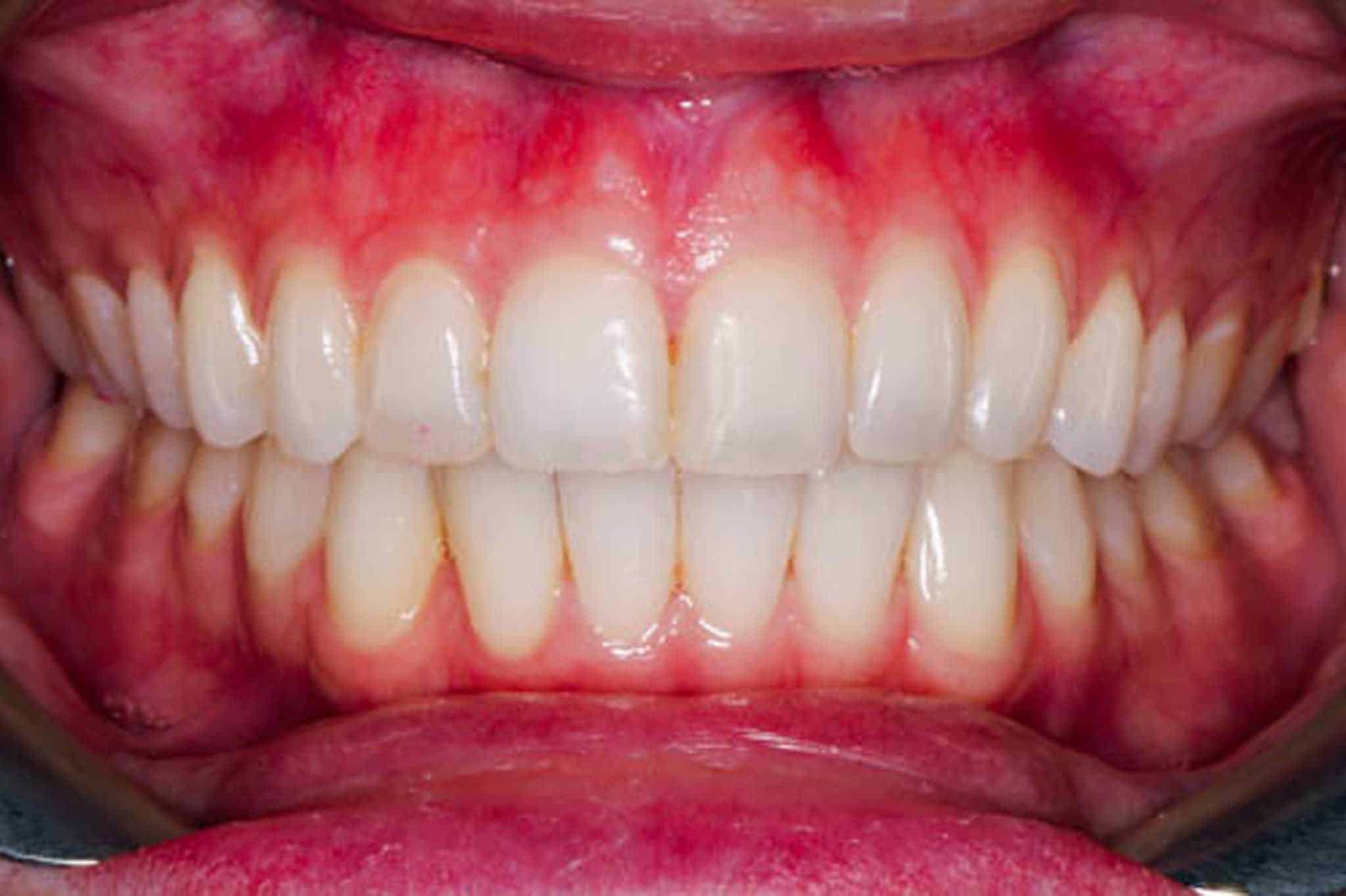 12-0-7-Kolbotn-Tannklinikk-Tannbleking-Blekeskinne-Før Før- og etterbilde: Tannleger på Kolbotn Tannklinikk dokumenterer tannbleking – Kolbotn, Sofiemyr, Nordstrand og Greverud.