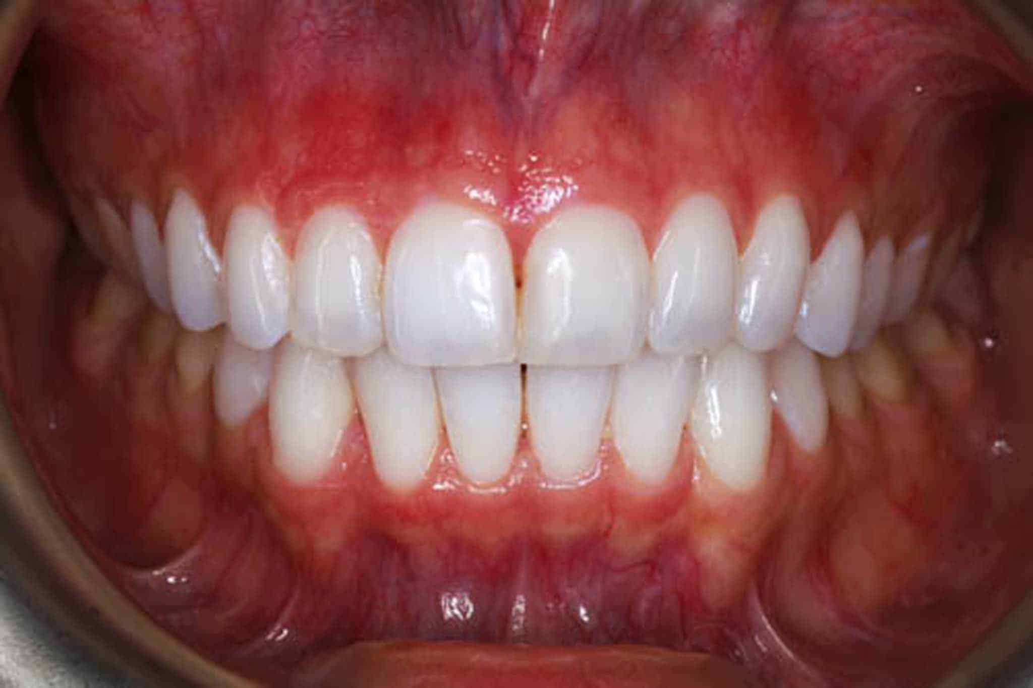 Før- og etterbilde: Tannleger på Kolbotn Tannklinikk dokumenterer tannbleking – Kolbotn, Sofiemyr, Nordstrand og Greverud.