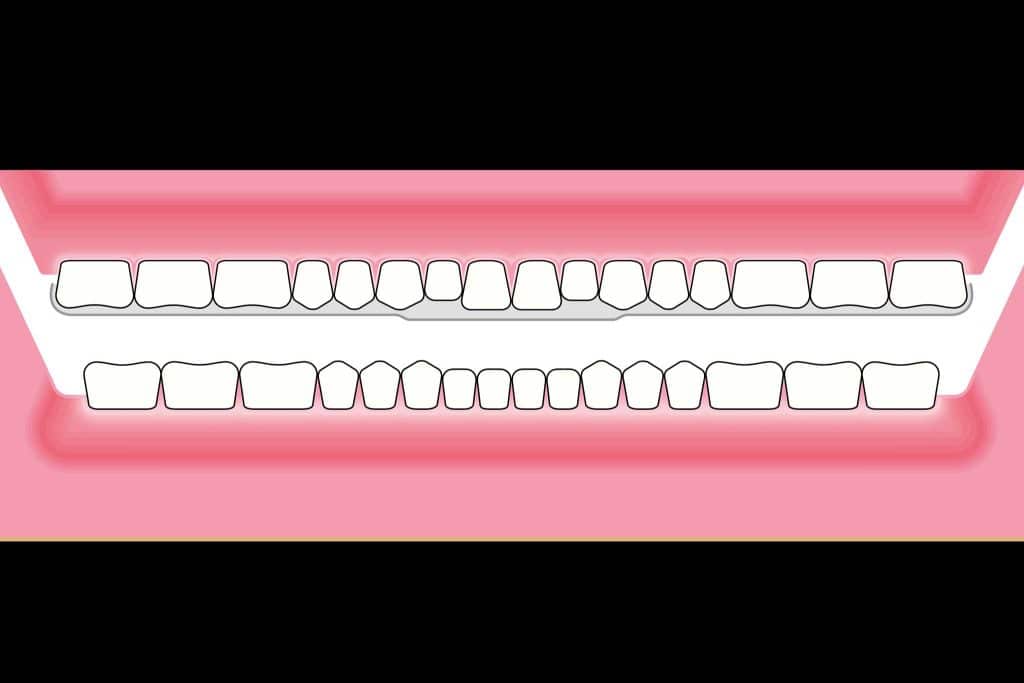Tannlegene på Kolbotn Tannklinikk benytter bittskinner for å lindre tanngnissing og TMD-plager – Kolbotn, Vinterbro, Myrvoll og Greverud.