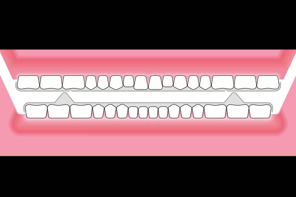 Ved Kolbotn Tannklinikk brukes snorkeskinner for å redusere snorking og bedre søvn – Kolbotn, Follo, Sofiemyr og Holmlia.