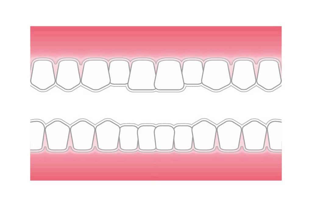 Tannlegene ved Kolbotn Tannklinikk tilbyr Invisalign-skinner som usynlig regulering – Kolbotn, Follo, Greverud og Oppegård.