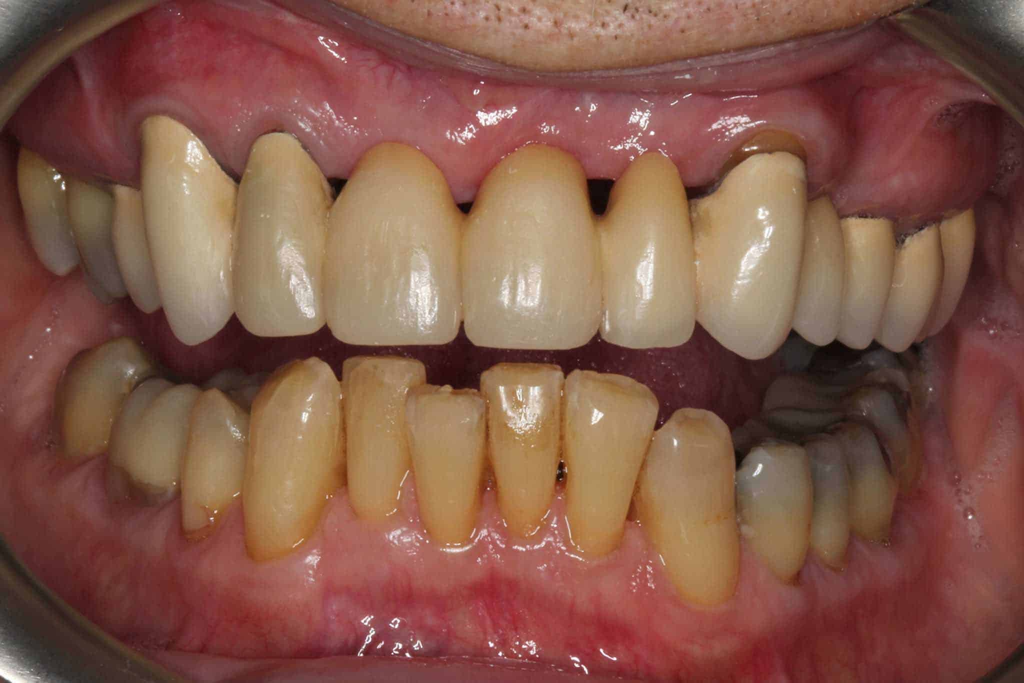 Før- og etterbilde: Hos Kolbotn Tannklinikk bygges skadde tenner opp med komposittmateriale – Kolbotn, Follo, Myrvoll og Holmlia.