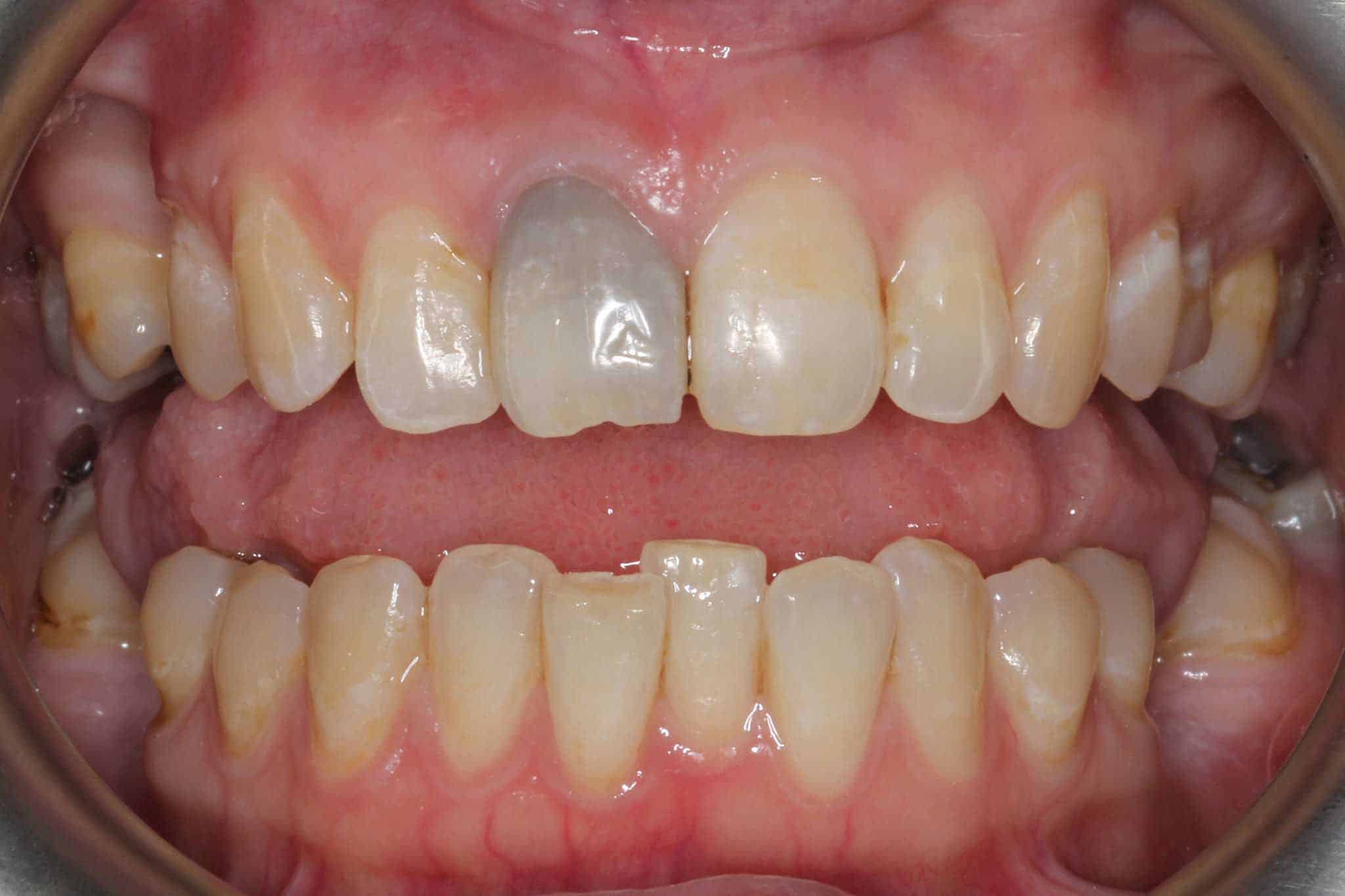 Før- og etterbilde: Ved Kolbotn Tannklinikk erstattes en tapt tann med implantat for naturlig resultat – Kolbotn, Follo, Oppegård og Nordstrand.