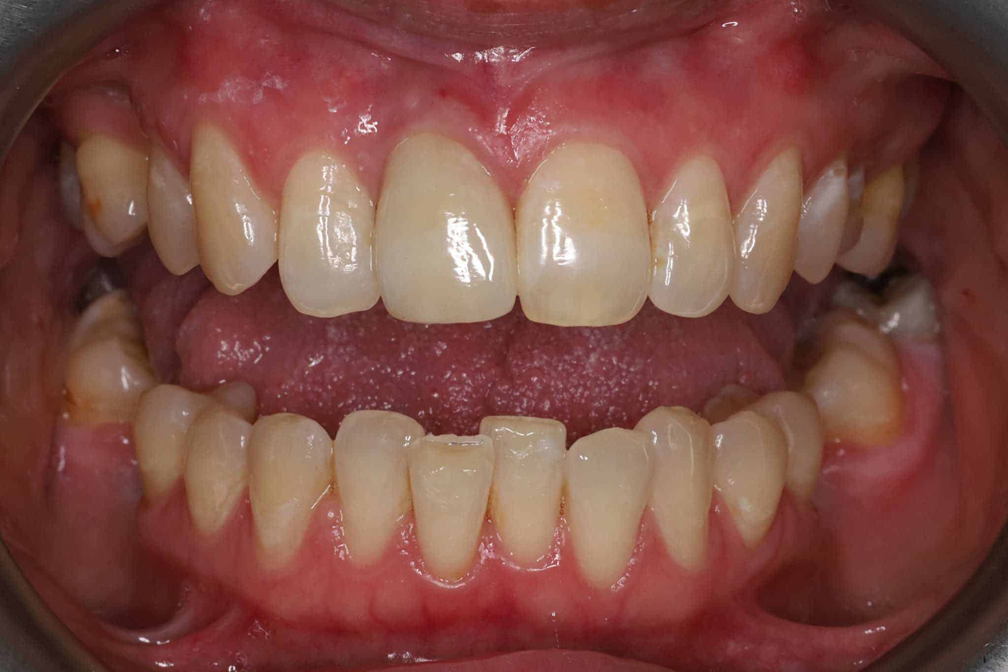 Bildet viser en fortann som ble fjernet og erstattet med implantat.