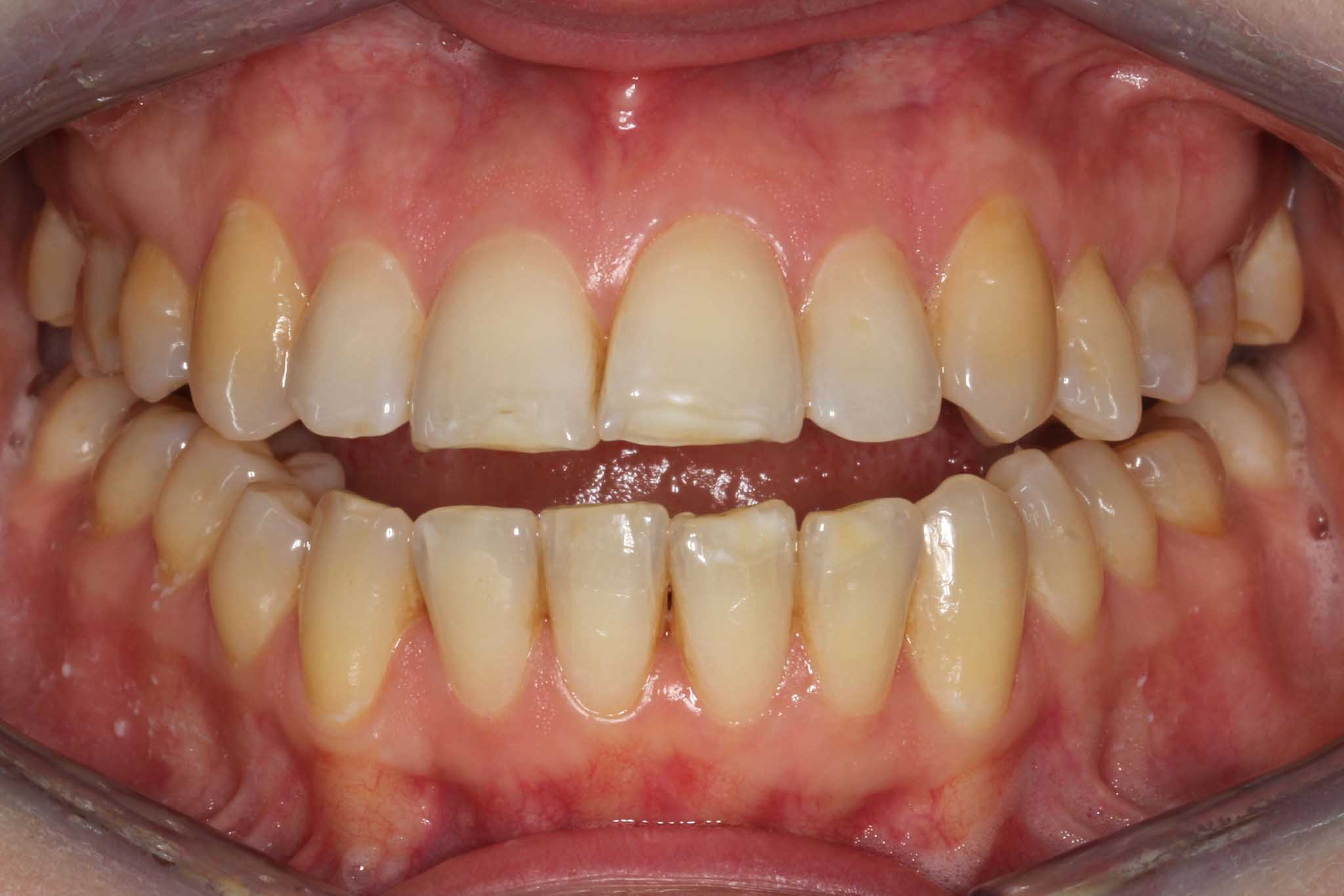 Før- og etterbilde: Hos Kolbotn Tannklinikk erstattes gamle fyllinger med estetisk kompositt – Kolbotn, Follo, Greverud og Nordstrand.