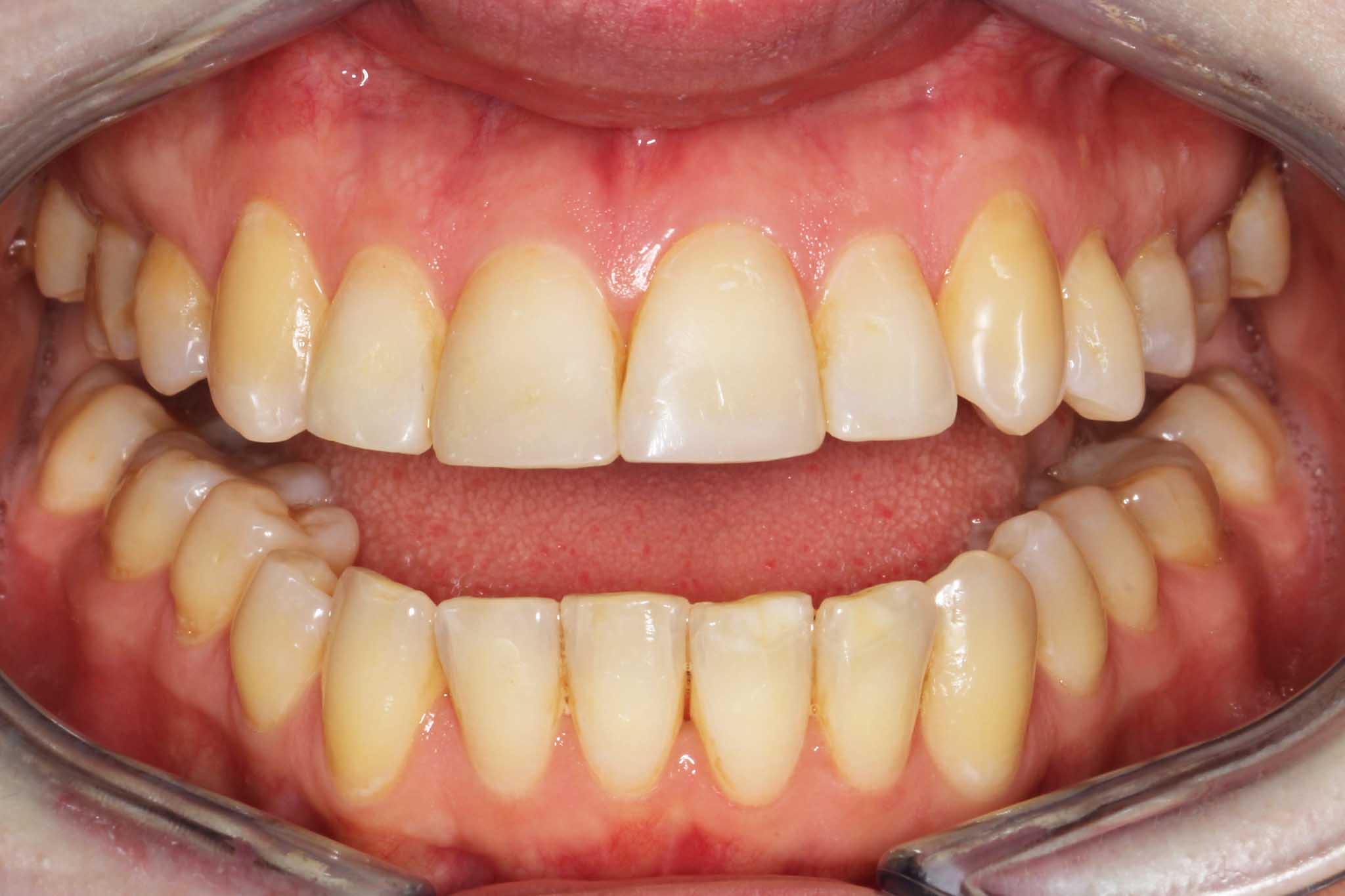 Bildet viser utskiftning av gamle fortannsfyllinger.