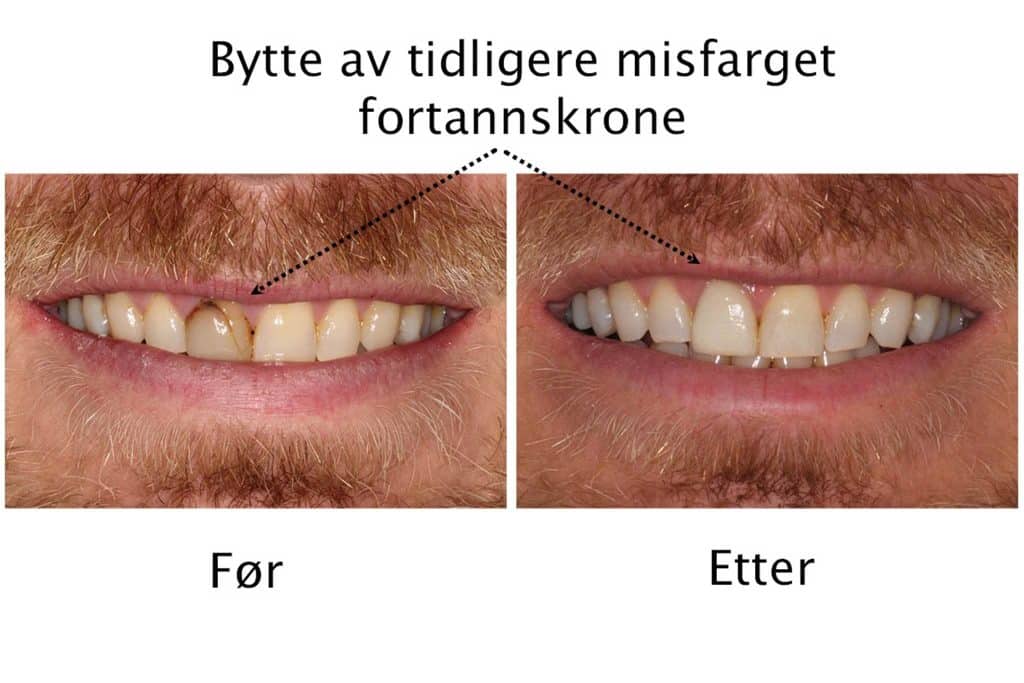 Galleri: Hos Kolbotn Tannklinikk brukes estetiske tannkroner for å reparere og styrke tenner – Kolbotn, Follo, Holmlia og Sofiemyr.