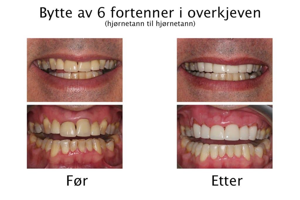 Galleri: Tannleger på Kolbotn Tannklinikk viser resultater av utskiftede kroner – Kolbotn, Follo, Greverud og Oppegård.