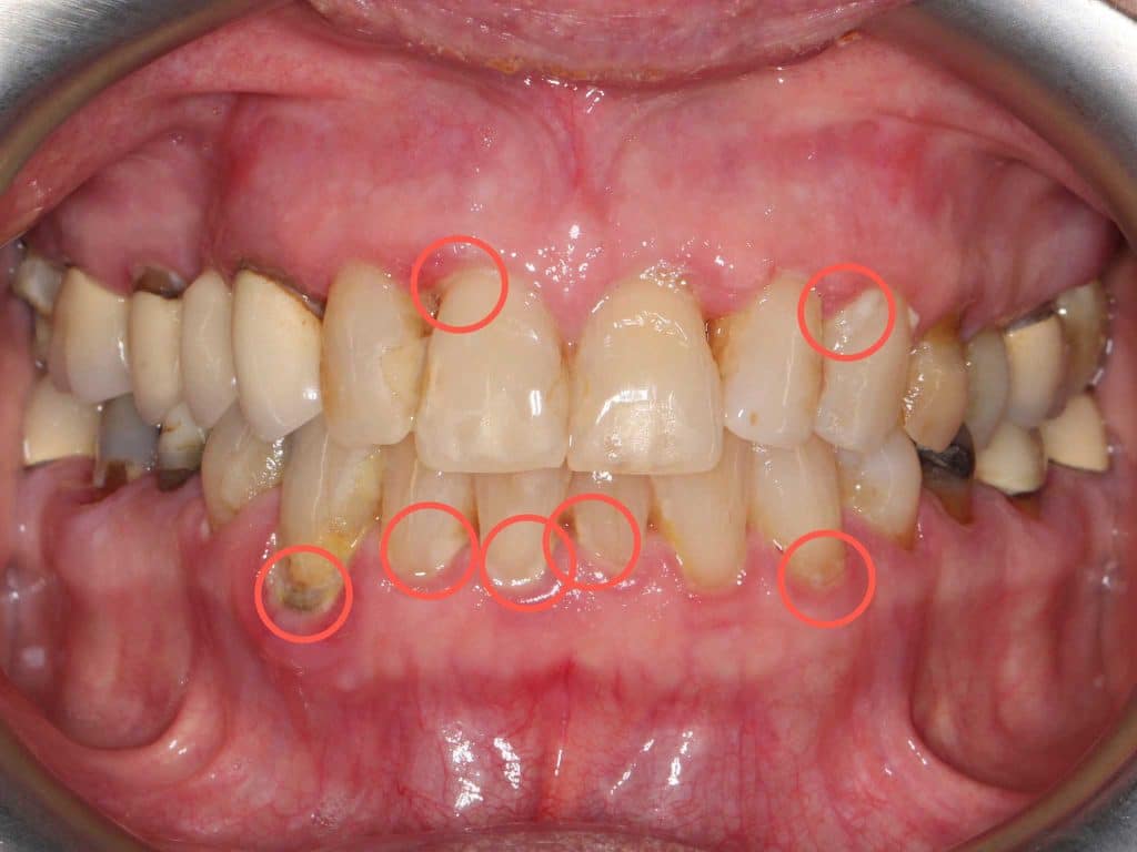 Tannlegene på Kolbotn Tannklinikk viser hvordan dårlig munnhygiene gir belegg, bakterier og dårlig ånde – Kolbotn, Follo, Greverud og Myrvoll.