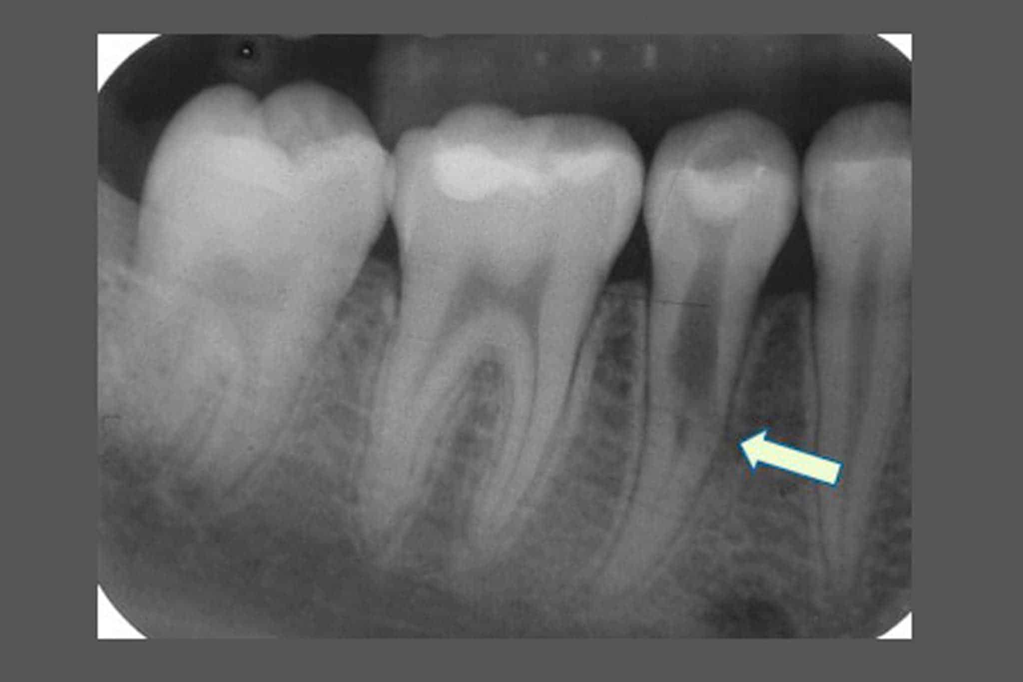Ved Kolbotn Tannklinikk oppdages intern resorpsjon tidlig med moderne røntgen – tannlege i Kolbotn, Follo, Oppegård og Nordstrand.