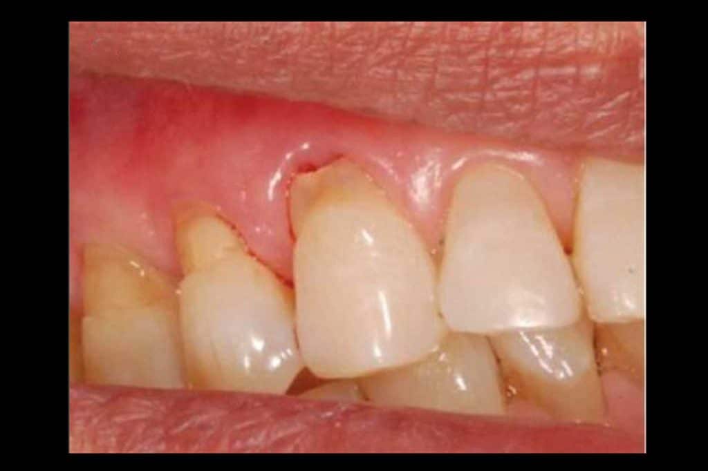 Hos Kolbotn Tannklinikk viser vi eksempel på ekstern resorpsjon i hjørnetann – behandles av erfarne tannleger i Kolbotn, Follo, Holmlia og Vinterbro.