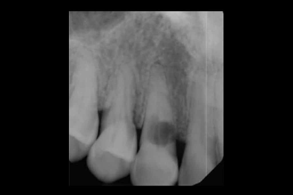 Tannlegene ved Kolbotn Tannklinikk oppdager ekstern resorpsjon med røntgen og 3D-bilder – Kolbotn, Myrvoll, Sofiemyr og Oppegård.