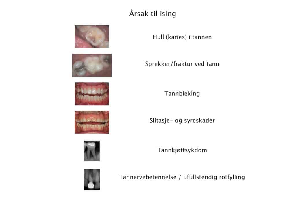 Hos Kolbotn Tannklinikk illustreres vanlige årsaker til ising i tennene – Kolbotn, Follo, Oppegård og Nordstrand.